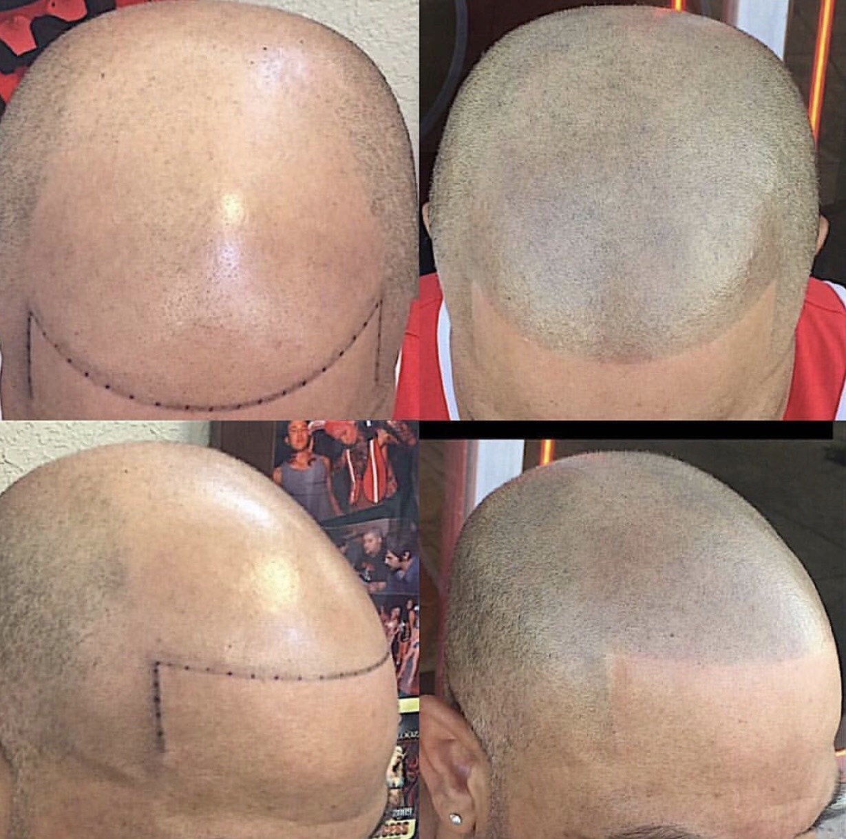 Scalp Saç Simülasyonu 